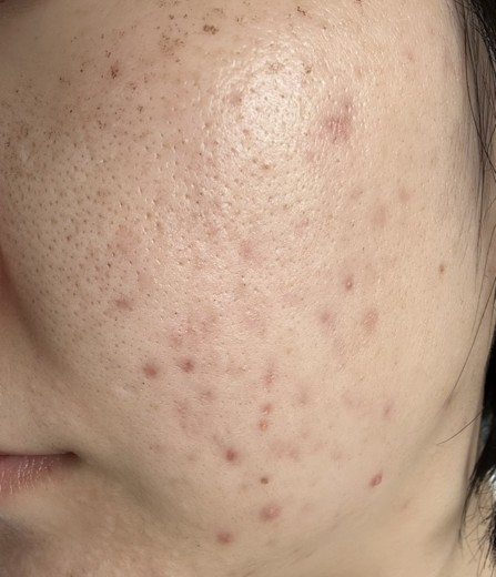 after photo: IPL(光/フォト治療), 診断・検査