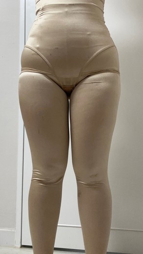 after photo: 전신지방흡입