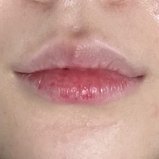 after photo: 입꼬리보톡스