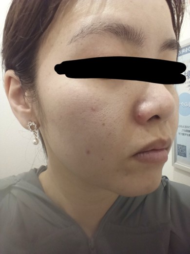 before photo: ダーマペン