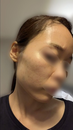 after photo: 脂肪溶解注射(腕), 脂肪溶解注射(太もも)