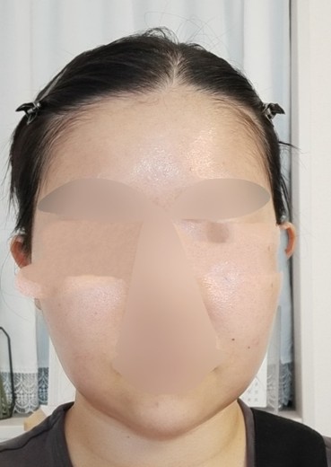 before photo: ウルトラセルQ+(ハイフ)