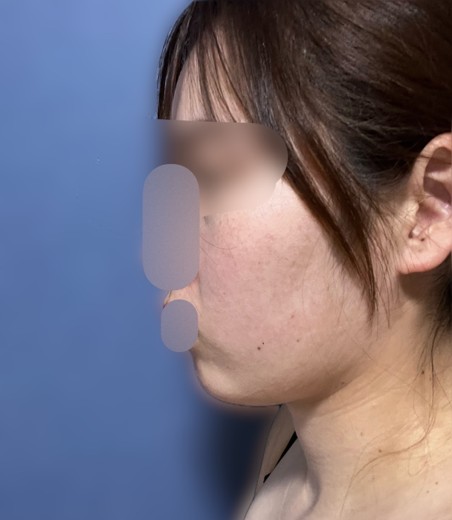 after photo: ハイフ(HIFU)