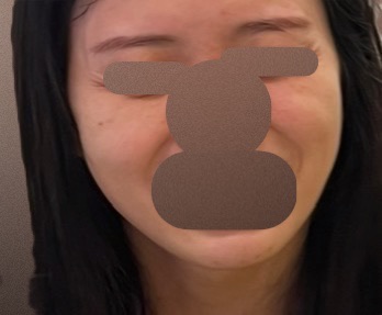 エレクトロポレーション＋ピーリング | フォンタナクリニック天神