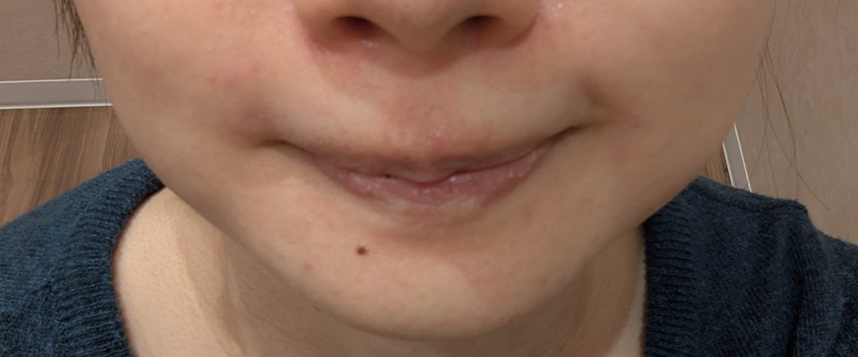 before photo: 口角ボトックス
