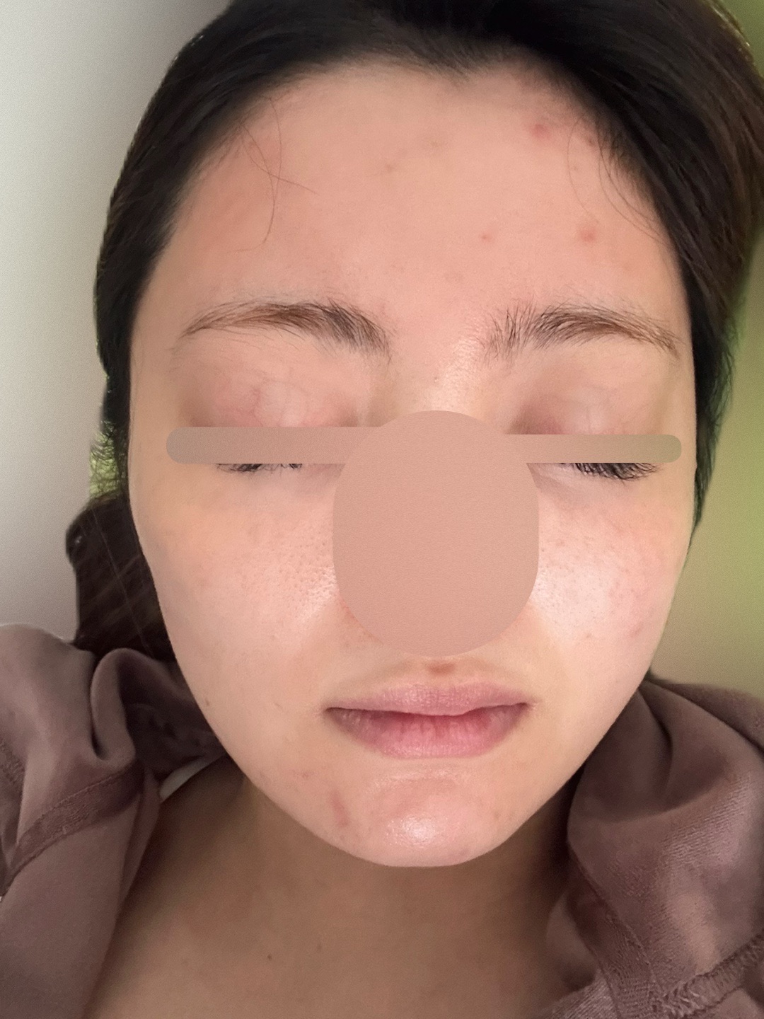 Hello face ダウンタイム腫れケアライト sddefault.jpg