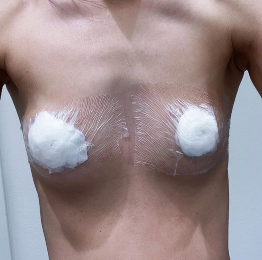 after photo: 乳輪縮小