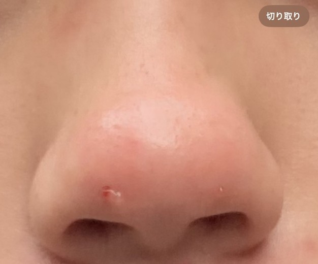 after photo: 脂肪溶解注射(顔)