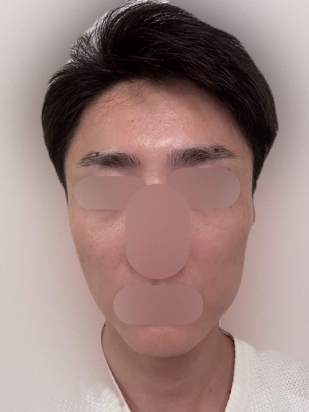 何度でも可】【男性限定】ヒゲ脱毛（髭全体）｜ジェントルマックスプロ