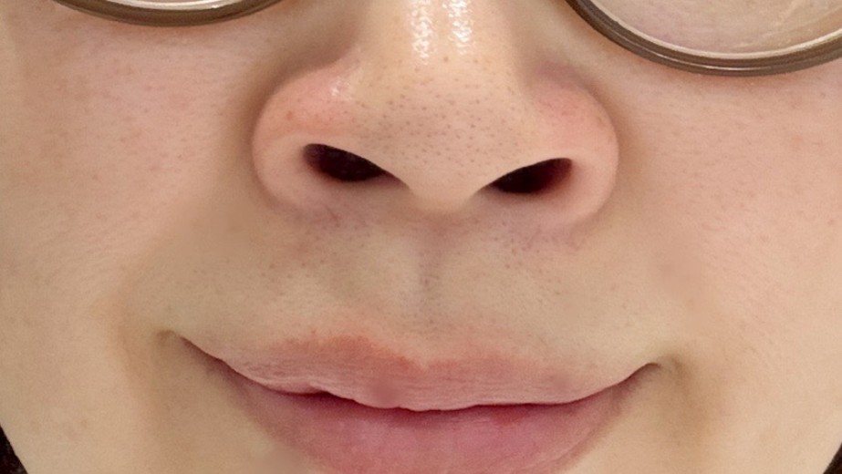 before photo: 小鼻ボトックス, 鼻先ボトックス