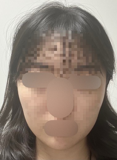 after photo: 사각턱보톡스