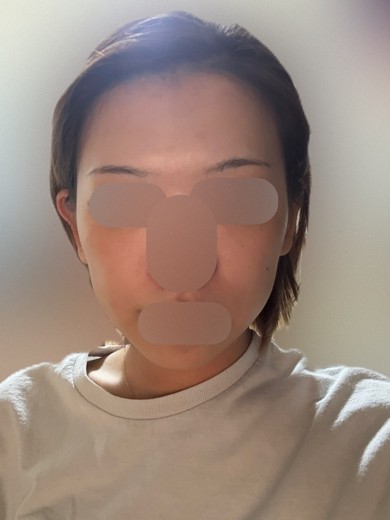 after photo: IPL(光/フォト治療)