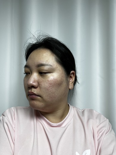 before photo: 점제거시술, V레이저