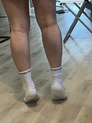 after photo: ふくらはぎボトックス, エラボトックス