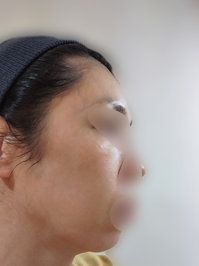 after photo: IPL(光/フォト治療)