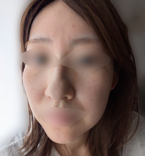 after photo: IPL(光/フォト治療), ピーリング