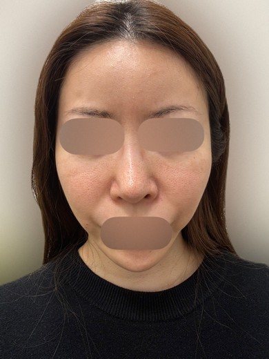 after photo: ジュベルック(Juvelook)