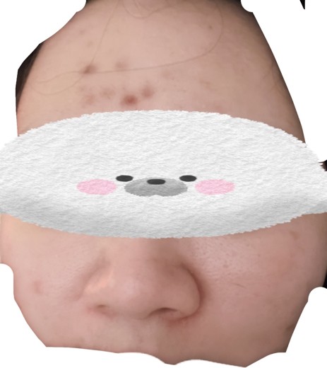 after photo: ジュベルック(Juvelook), サブシジョン(ニキビ跡治療)