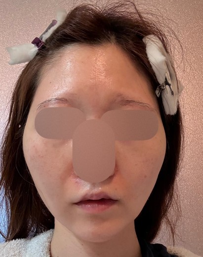 after photo: フラクショナルレーザー, エレクトロポレーション, Qスイッチレーザー