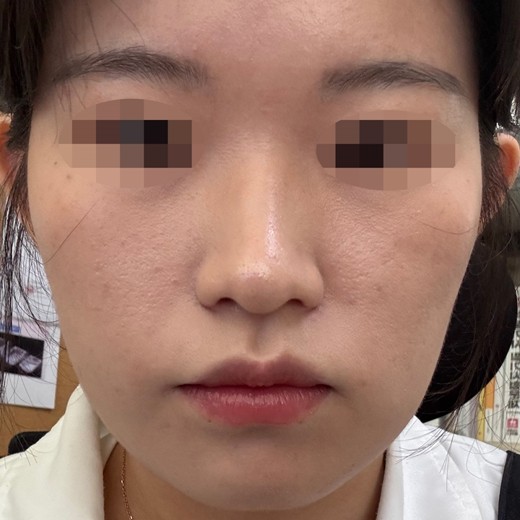 after photo: 콧볼축소