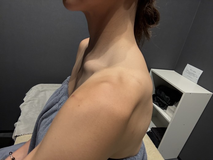 before photo: 肩ボトックス(僧帽筋), 唾液腺ボトックス, 首・広頚筋ボトックス