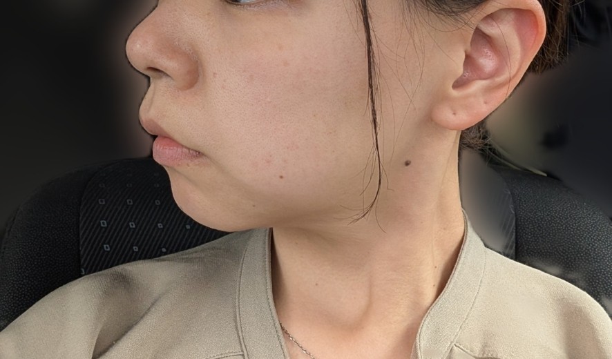 before photo: ソノクイーン(ハイフ)