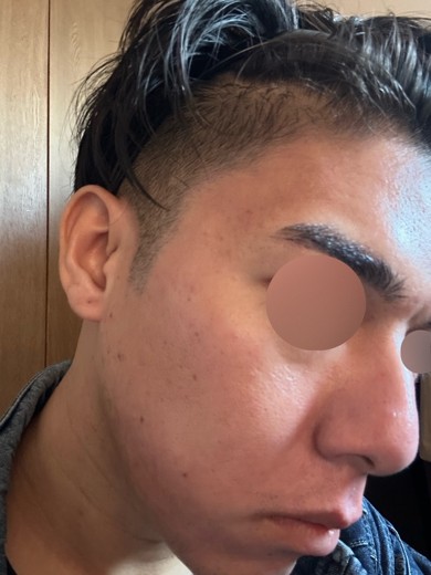 after photo: ダーマペン, エクソソーム