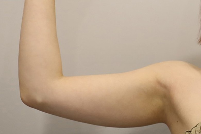 before photo: 팔지방분해주사