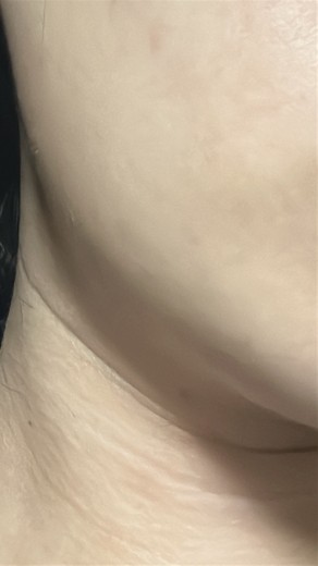 after photo: 脂肪溶解注射(顔)