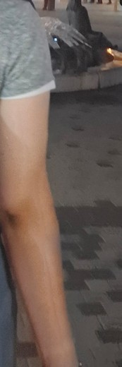 before photo: 인모드바디