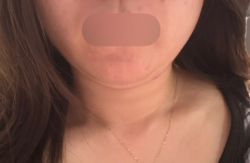 before photo: 인모드리프팅, 윤곽주사, 사각턱보톡스