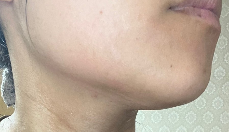 before photo: 脂肪溶解注射(顔)