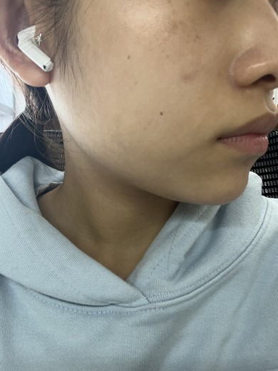 before photo: 피코토닝