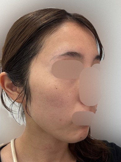 before photo: ルメッカ