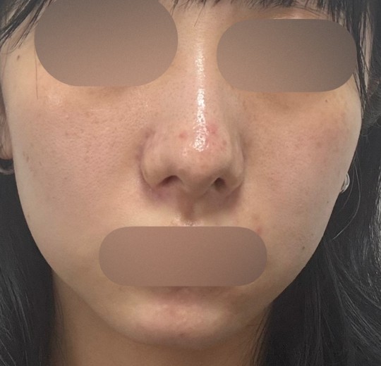 after photo: ララピール(LHAピーリング)