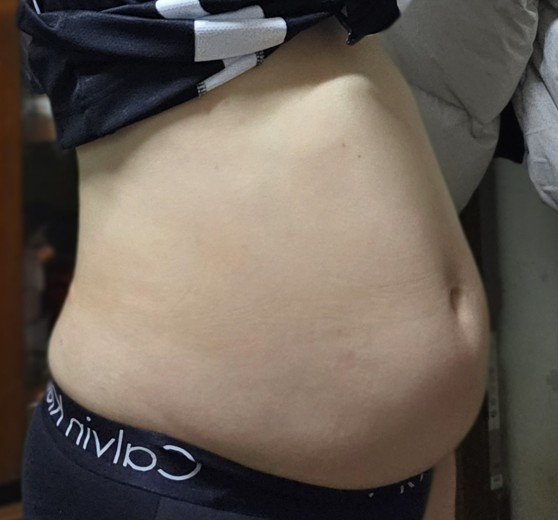 before photo: 복부지방흡입