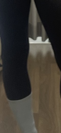 after photo: 종아리보톡스