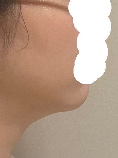 after photo: 脂肪吸引(顎下)