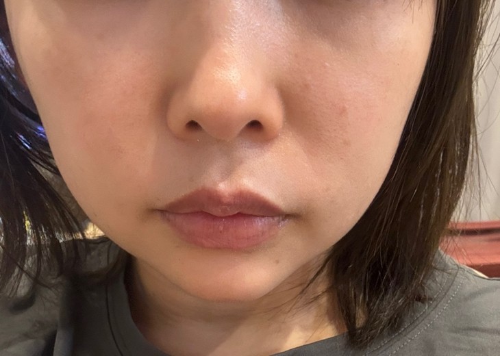 after photo: あごヒアルロン酸, 頬ヒアルロン酸
