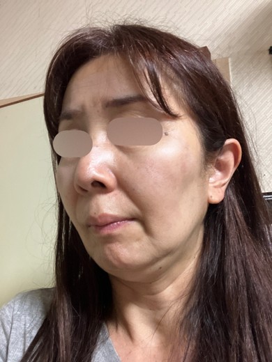 after photo: エレクトロポレーション