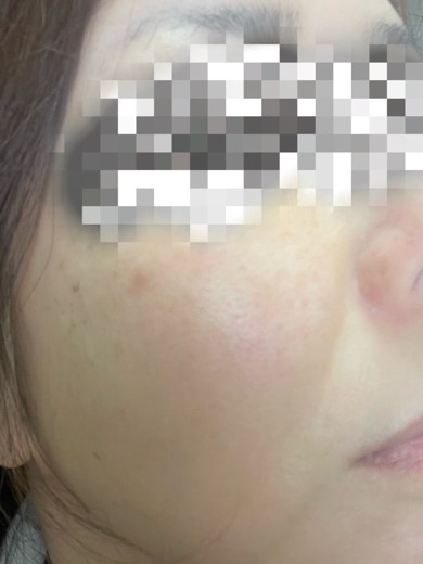 after photo: ピーリング, ルメッカ