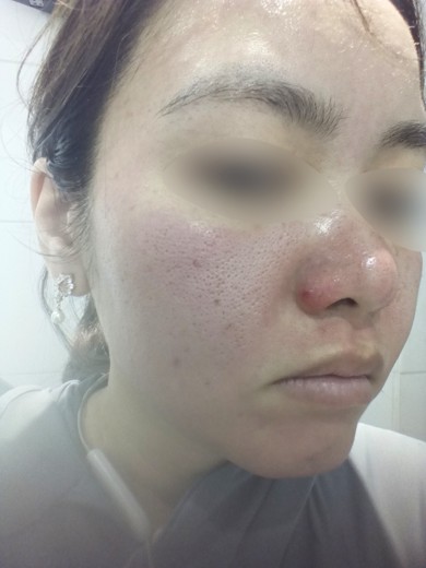 after photo: ダーマペン