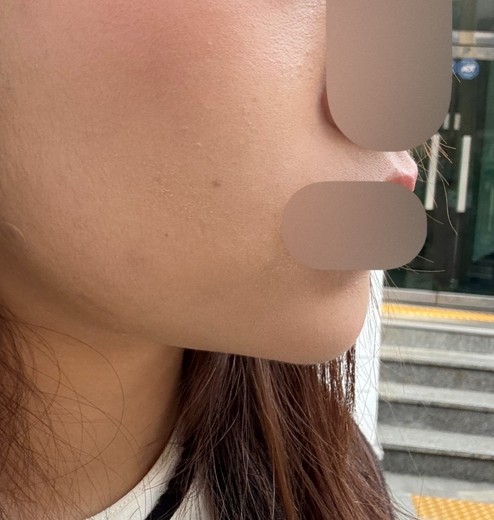 after photo: 턱끝필러