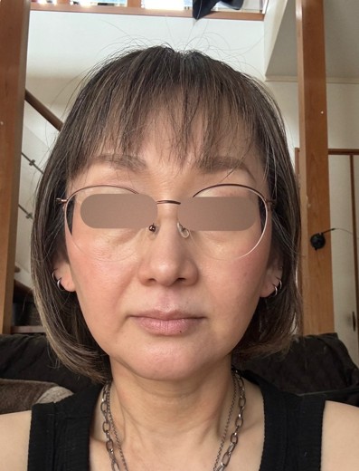 after photo: リニアファーム(ハイフ)