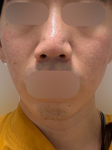 before photo: ダーマペン