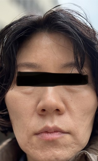 before photo: 리쥬란힐러