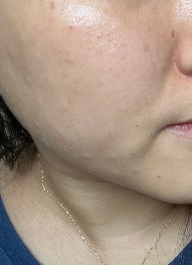 after photo: 윤곽주사