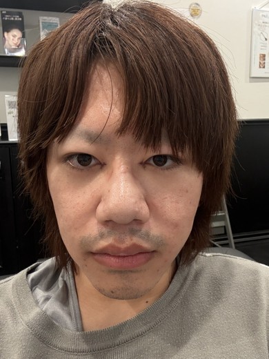 before photo: 脂肪溶解注射(顔)