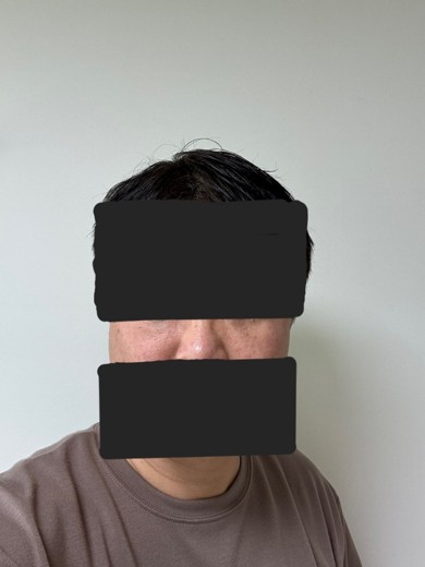 after photo: 눈밑지방재배치