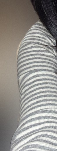 after photo: 팔지방분해주사